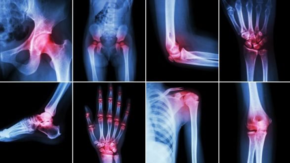 durere în spatele tratamentului articulației genunchiului Clinica și tratamentul artrozei deformante
