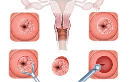 distrugerea colului uterin osteoartrita deformatoare de gradul III tratament